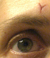 Image of an eye with a scar over it in the shape of a Y